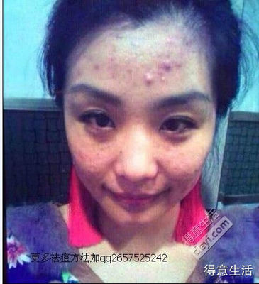 怎么祛痘最快最有效