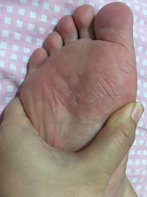 怀孕 脚气