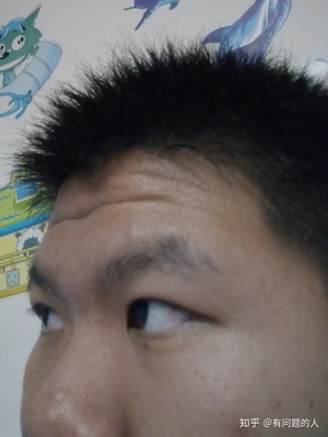 男生鼻子长痘痘的原因