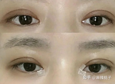割双眼皮修复多少钱