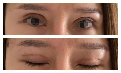 双眼皮太肿