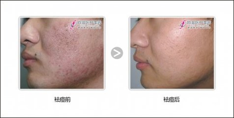 痘痘肌可以用蜂蜜敷脸吗