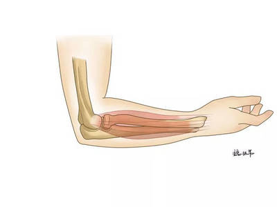 网球肘怎么治疗才能彻底恢复