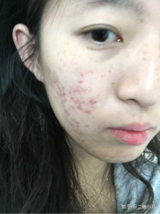 脓包型痤疮怎么治疗