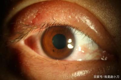 内睑腺炎怎么治疗