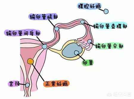 一根输卵管能怀孕吗