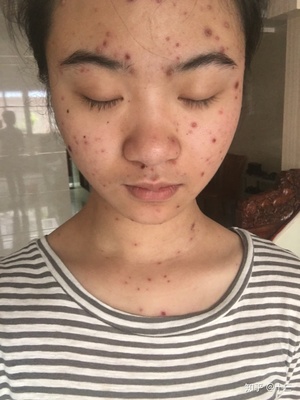 脸上的痘痘变红怎么办