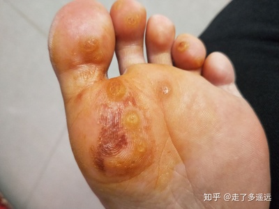 脚上长疣怎么治疗