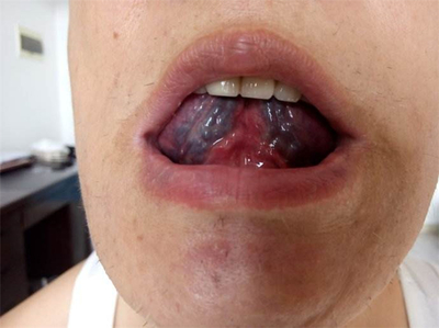 舌下取血栓多少钱