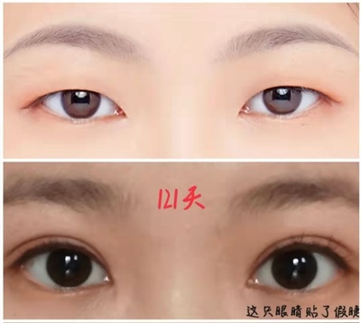 韩式做双眼皮价格