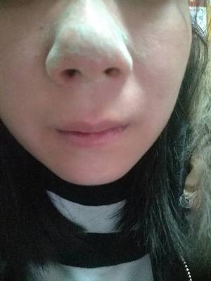 怀孕鼻子变大变红