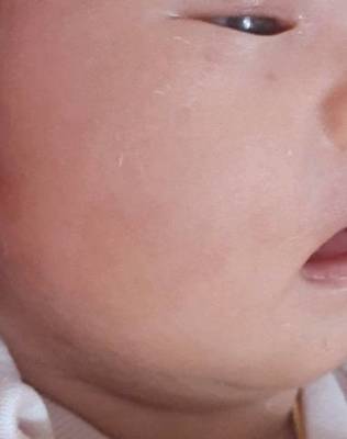 新生儿咖啡斑会消退吗