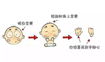 胆红素脑病怎么治疗