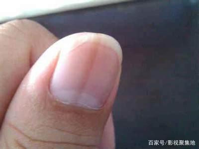 指甲有横纹是怎么回事