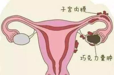 宫颈囊肿是怎么回事