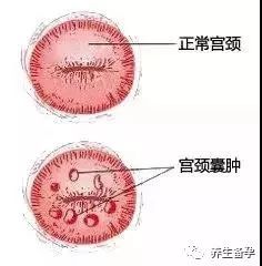 宫颈囊肿是怎么回事