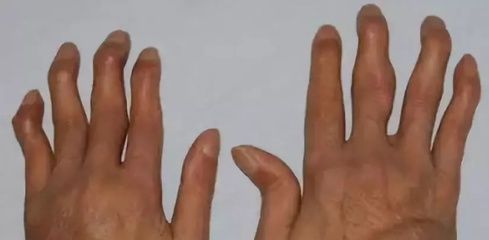 手指关节风湿怎么治疗