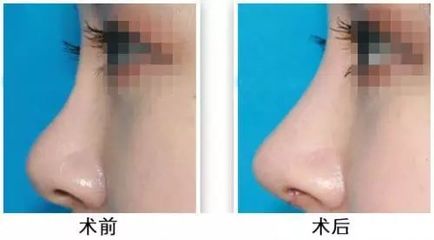 隆鼻有哪几种