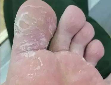 脚蜕皮是怎么回事