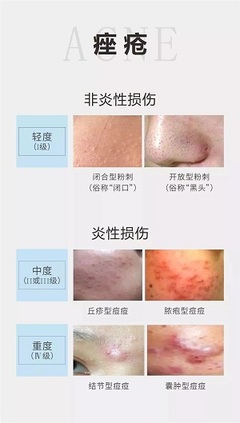 痤疮粉刺最有效的药