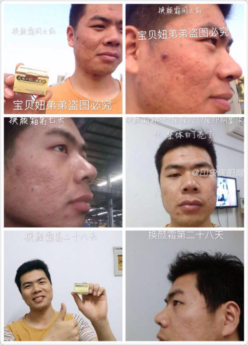 胶原蛋白会长痘痘吗