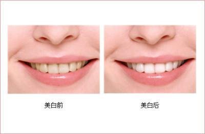 牙齿美白的副作用