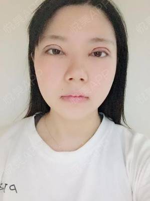 割双眼皮消炎针打几天