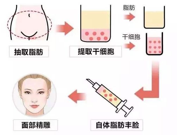 脂肪填充还是玻尿酸好