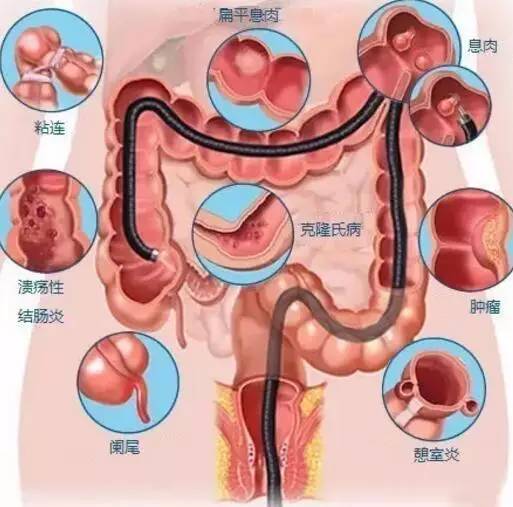 胃粘连怎么治疗方法