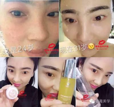脸上有痘痘能打水光针吗