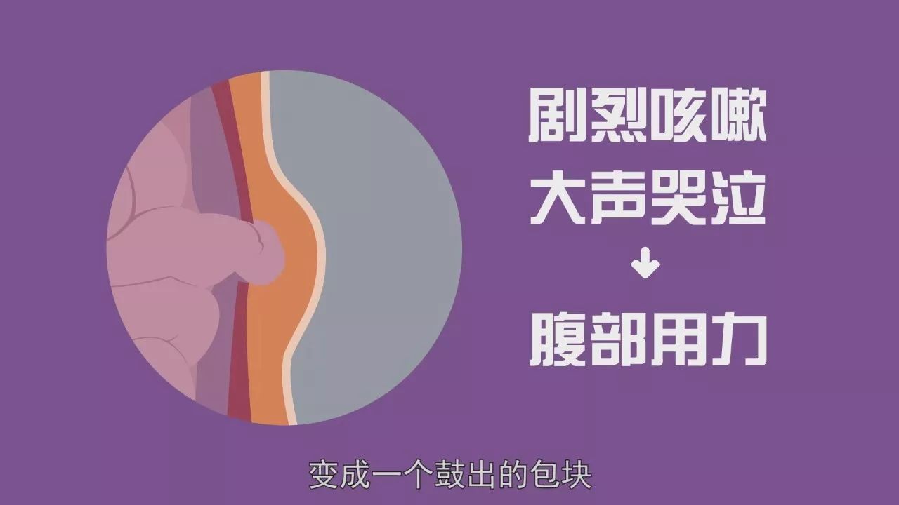 新生儿疝气
