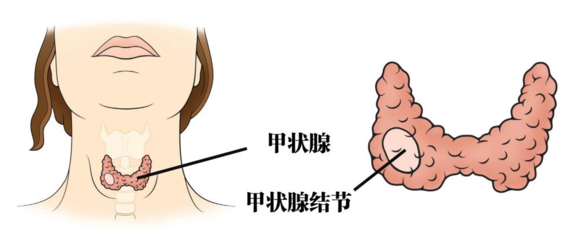 甲状腺结节的正常范围是多少