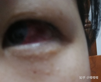 眼睛周围红是怎么回事