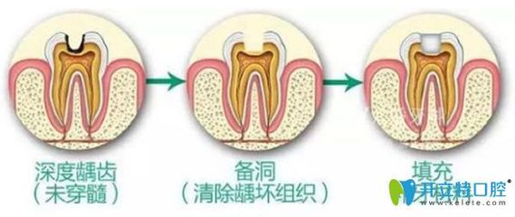 上海补牙多少钱