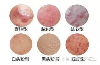 脓包型痤疮怎么治疗