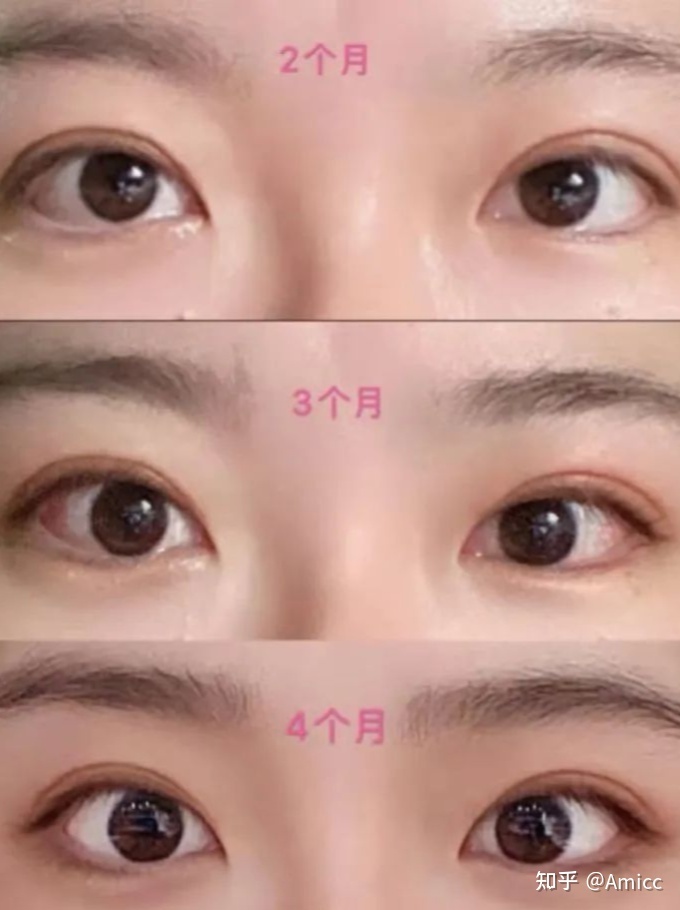 双眼皮如何修复