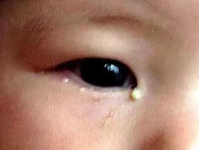 小眼角充血是怎么回事