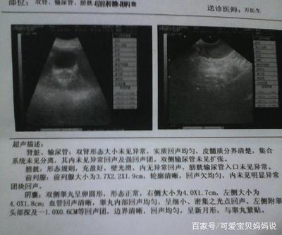 孕妇肾盂分离是什么意思
