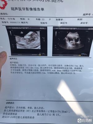 3个月的胎儿有多大