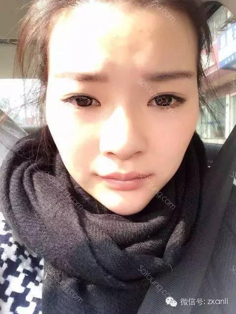 做了双眼皮发现怀孕了