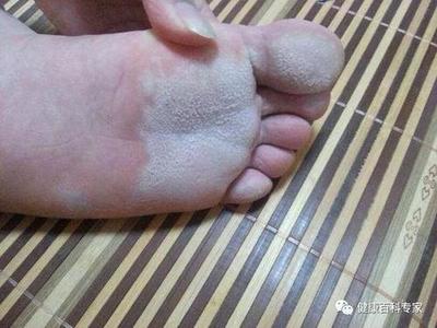 怀孕 脚气