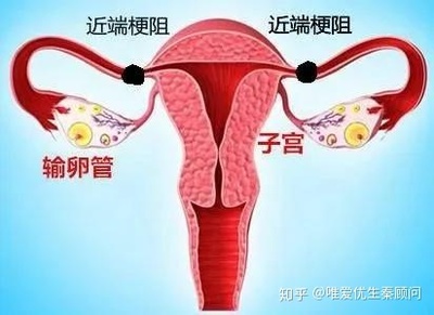 单侧输卵管怀孕的技巧