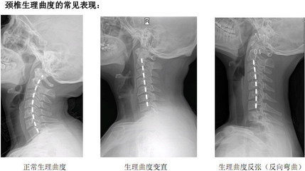 颈椎弯曲怎么治疗