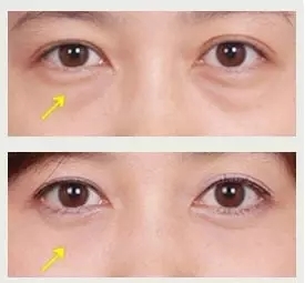 眼袋大是怎么回事