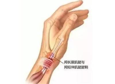 手指关节腱鞘囊肿怎么治疗