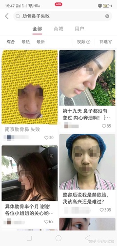 半肋骨隆鼻有后遗症吗