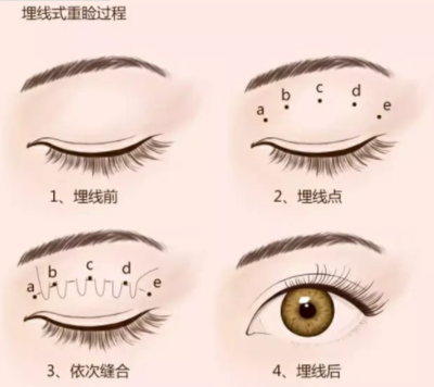 双眼皮的遗传