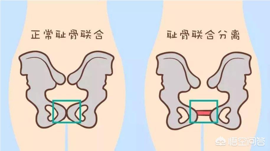 孕妇 耻骨联合分离