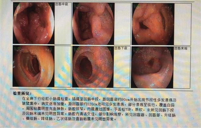 经肛小肠镜检查多少钱