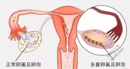 卵泡多怎么治疗
